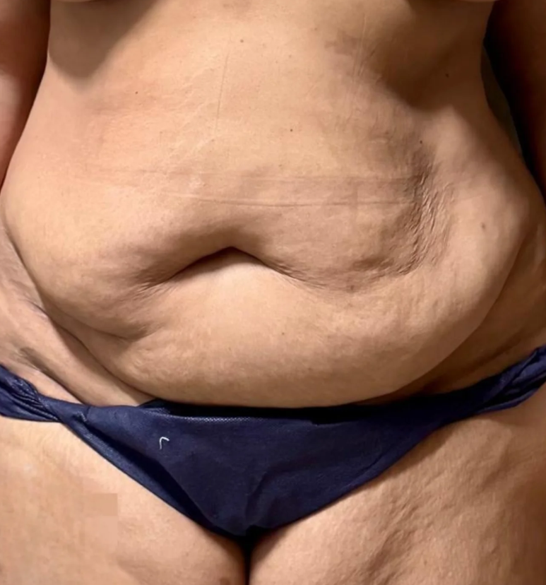 Abdominoplasty Before